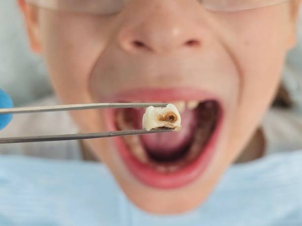 Best Emergency Treatment for Toothache in Rutherford, TN